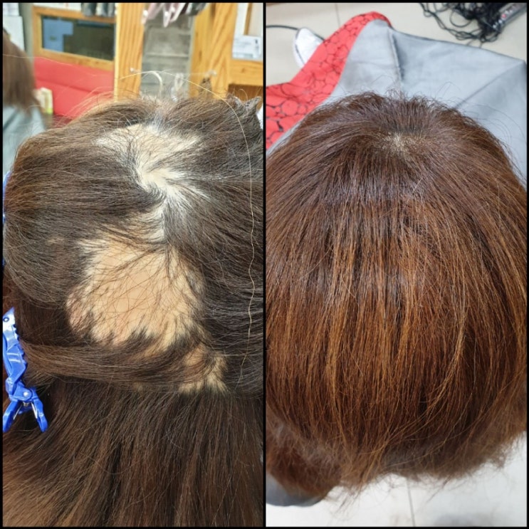  두피흉터ㆍ화상흉터 보여주기싫은 상처에ᆢ행복한 완벽커버!!  김호증모가발!!  [춘천가발전문점][이은주헤어살롱]