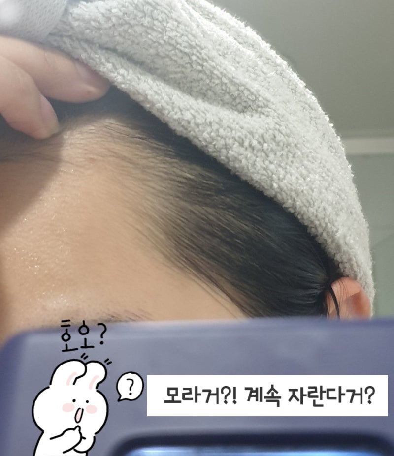여자 M자 탈모증 초기증상예방법 루토닉앰플 5