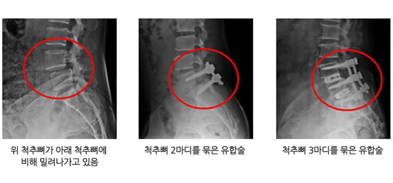 부산 척추관협착증 수술? 굳이 필요없어요