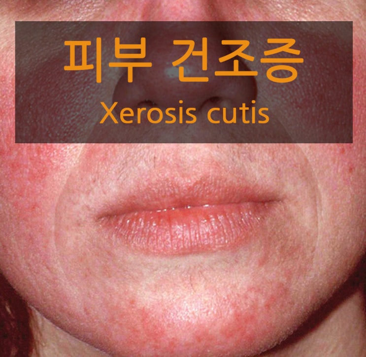  신논현역 피부과 '겨울이면 찾아오는 피부 건조증'