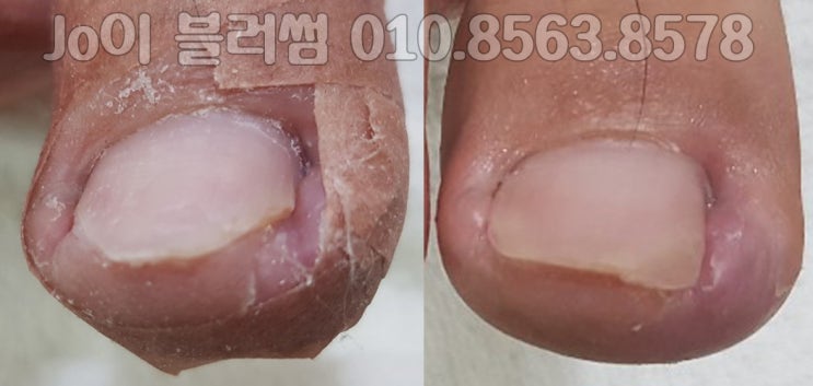  용인 군대 다녀온 후 생긴 무좀 발톱, 파고드는 발톱, 내성발톱 제대로 관리받자.