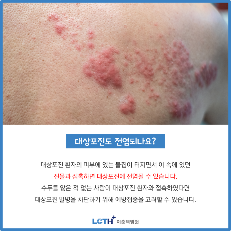 대상포진 전염성 50대 이상 위험, 9