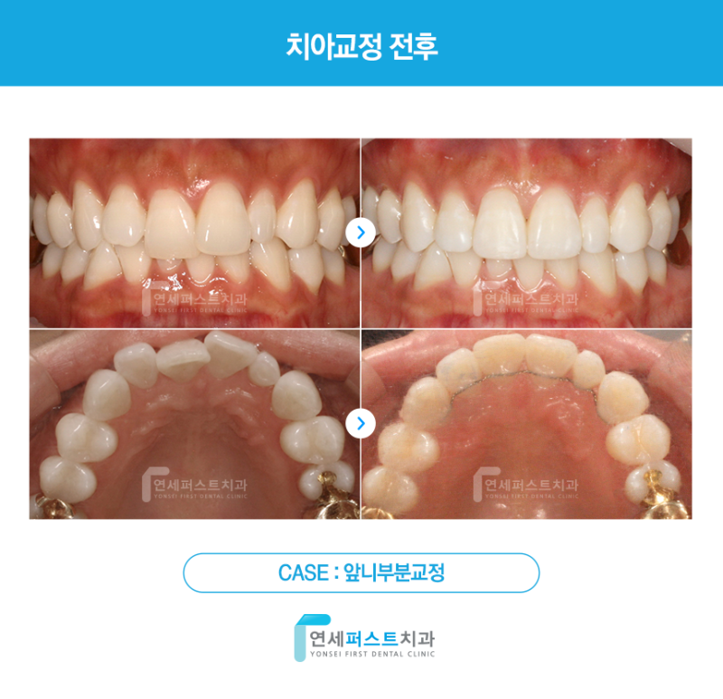 앞니 부분교정 치료기간과 부담을 줄이고 싶다면