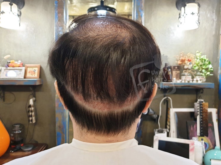  여의도 글로웰 의원 비절개 모발이식 후두부 붙임머리