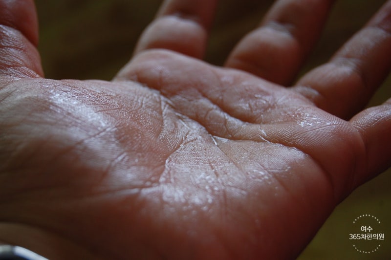 수족다한증과 땀을 조절해주는 한의원에서