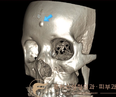 이마 골종 제거 과정 이마 골종 제거 과정