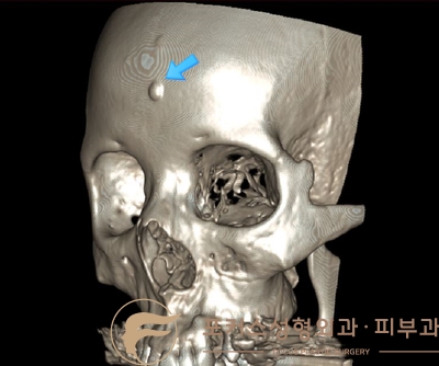 이마 골종 제거 과정
