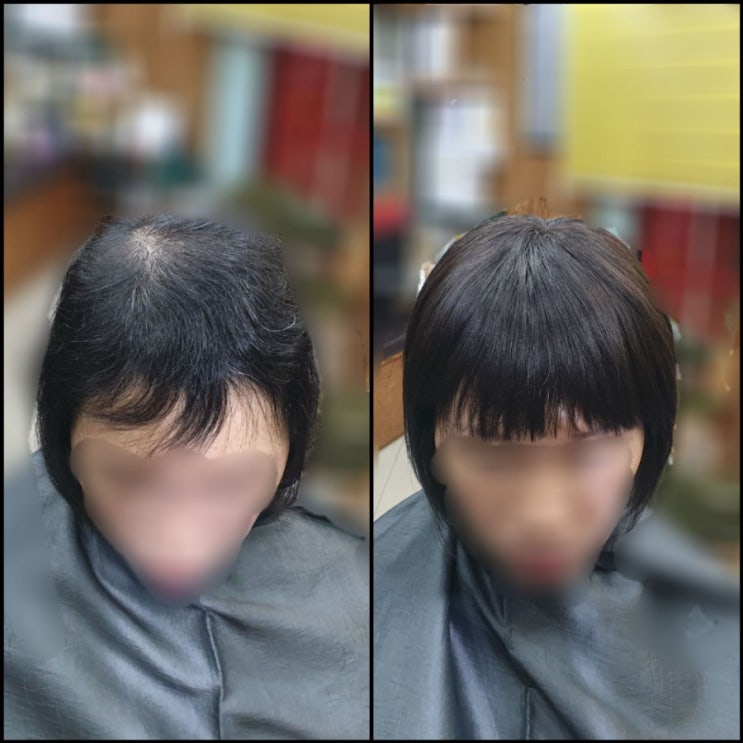  40대여성 모발이식보다 안전하고 확실하게 수술없는 헤어이식커버증모술로 일상에 자심감을 심자! [춘천가발전문점][김호증모][이은주헤어살롱]