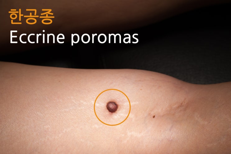  한공종 Eccrine poromas 제거 수술