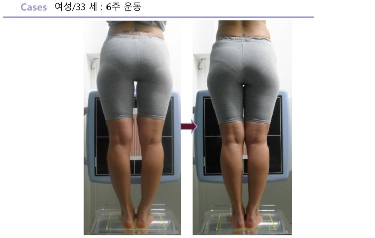  휜다리 운동으로 끝낼 수 있는 "스타일렉스Q" 실제 교정사례