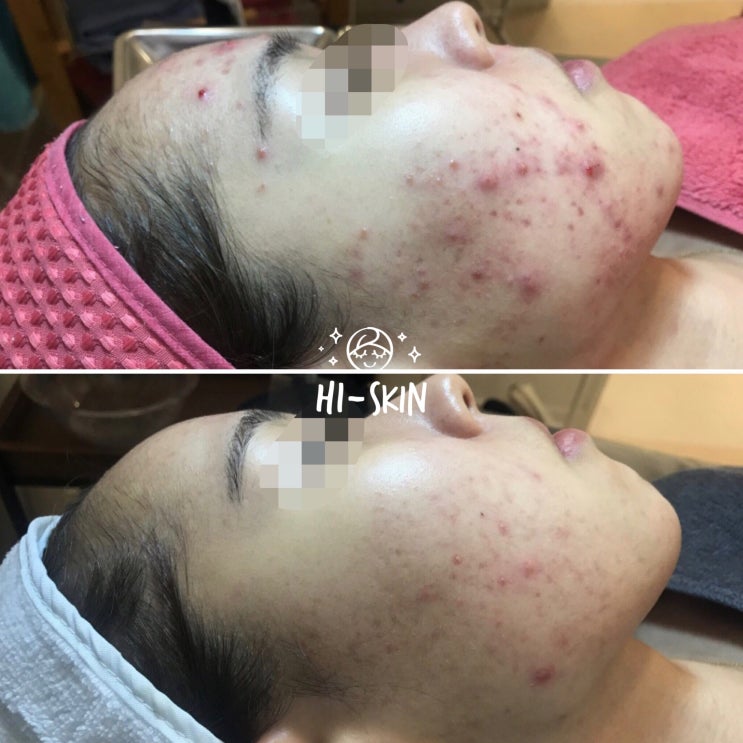  염증성여드름관리 화농성여드름관리 여드름흉터치료는 여드름압출잘하는곳 하이스킨