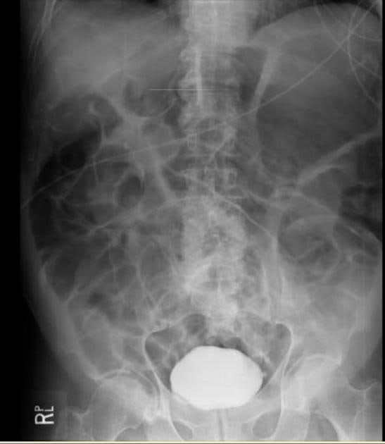 장폐색의 진단, adynamic ileus, paralytic ileus : 네이버 블로그