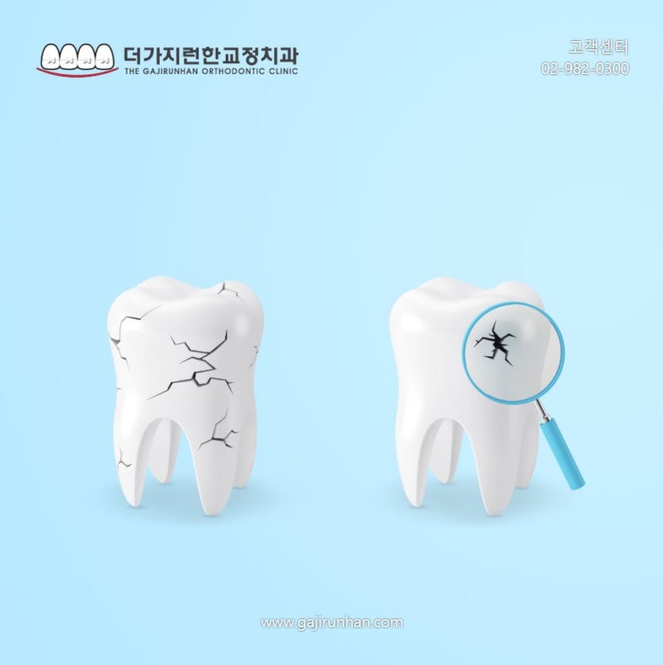  실금이 생긴 내 치아, 치아균열에 이라고요!
