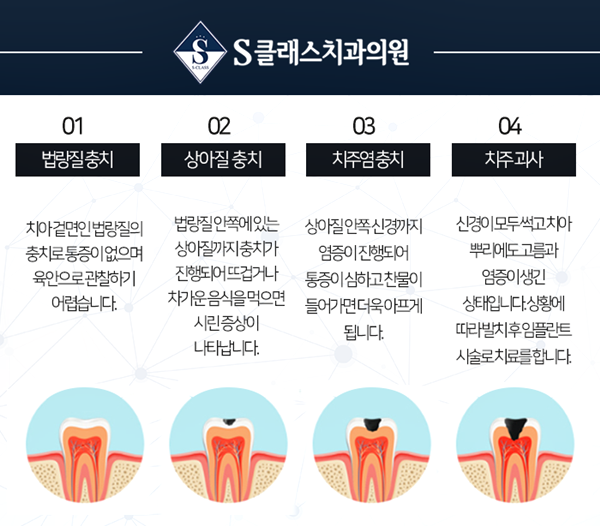 충치치료 후 통증이 발생하는 여러가지 이유가