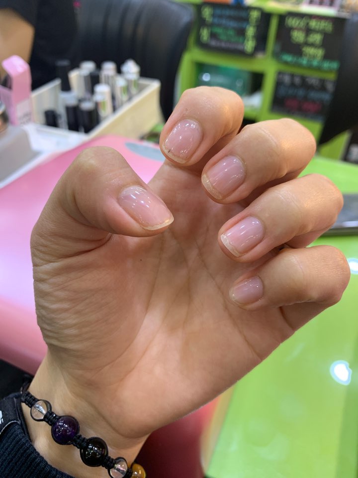  개구리 손톱, 못생긴 손톱! 손톱 교정 후 이쁜 바디 되찾기!