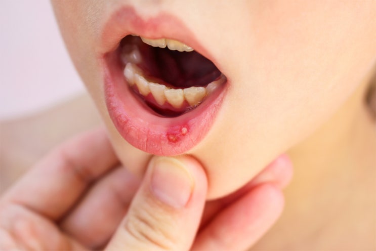 입속 염증, 구내염에 대처하는 방법
