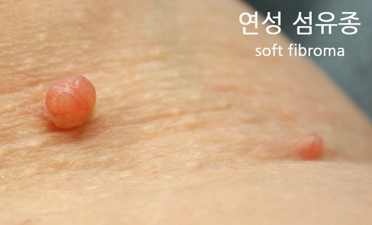  연성 섬유종 '각질 형성과 아교질 섬유의 증식'