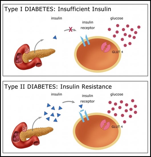 산전 보험 인슐린 의존 당뇨병 진단의 담보가 필요합니까?(+소아당뇨. 1형, 2형. 당뇨병 보험)