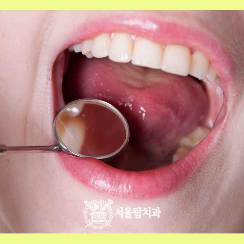 스케일링이 시린 걱정이라면? 2