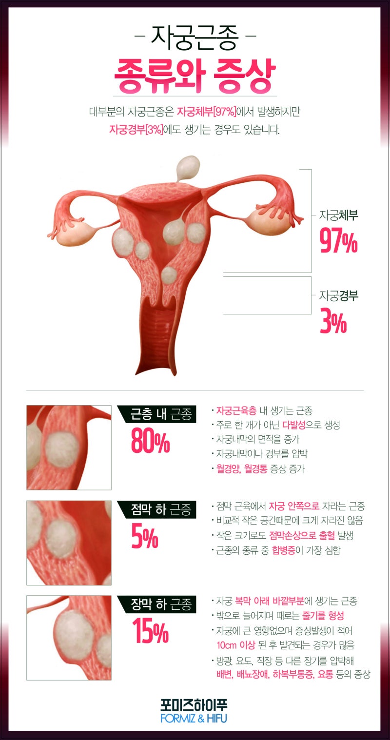 자궁선근증의 증상, 원인, 통증, 임신 수술을 조사합니다.