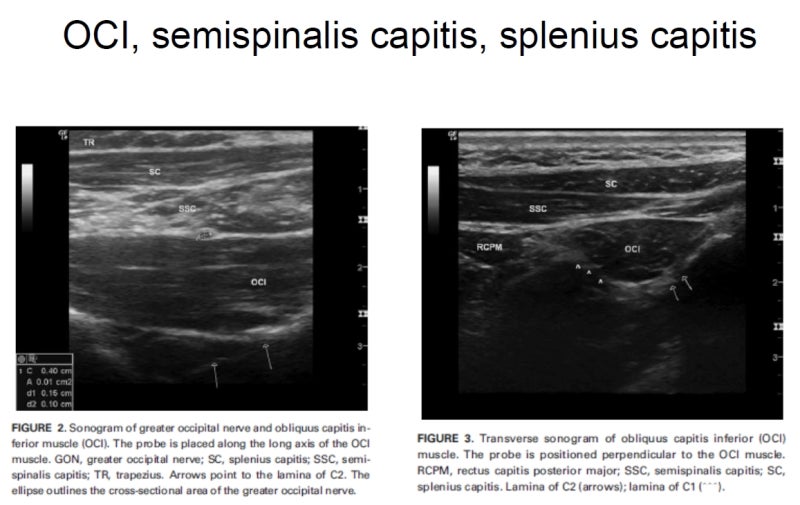 Semispinalis Capitis 두반극근 : 네이버 블로그