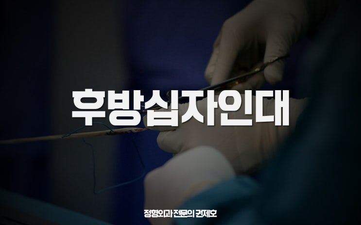  후방십자인대파열, 수술이 불가피한가요? feat 재건술정보
