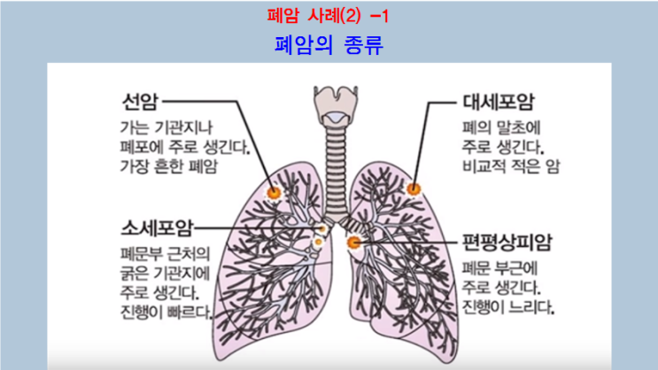  펜벤다졸 후기(57)-폐암2편,폐암치료효과사례