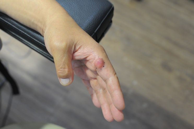 손가락 마디 혹 '피지낭종에 의한 통증과 행동 장애'