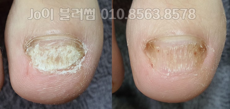  용인 엄지발톱의 부족한 부분 관리받을 수 있는 용인네일샵 조이블러썸