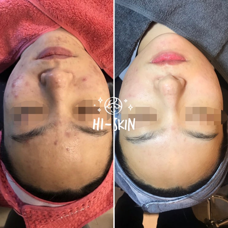  여드름색소침착 여드름흉터치료는 구로디지털단지피부관리실 하이스킨