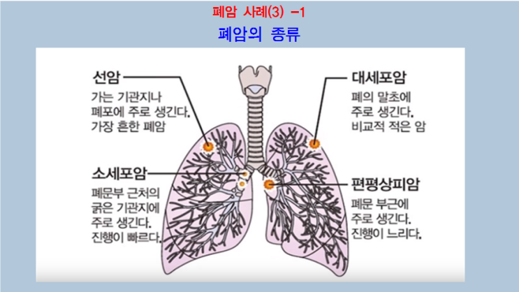  펜벤다졸 후기(58)-폐암3편,폐암치료효과사례