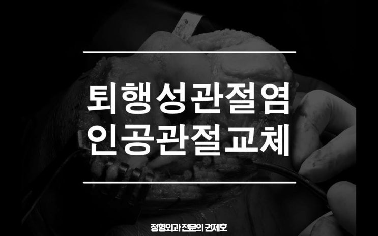  무릎인공관절 전치환술 TKA  관절통증 수술