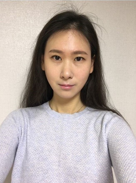  민트실리프팅가격 후회없어요