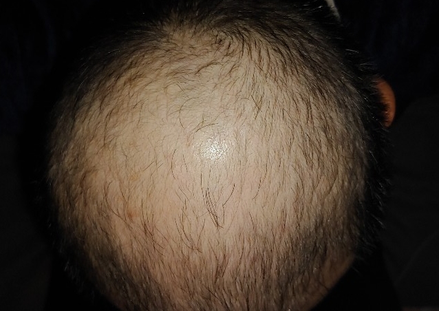  탈모치료 두타스테리드연질캡슐0.5mg(아보타드)을 병원처방으로 의료보험혜택 받아서 75일 사용한 후기내용입니다.실비보험청구가능