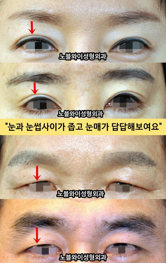 강남중년눈성형 하안검수술&미하거수술 1개월차 리뷰+비용,흉부