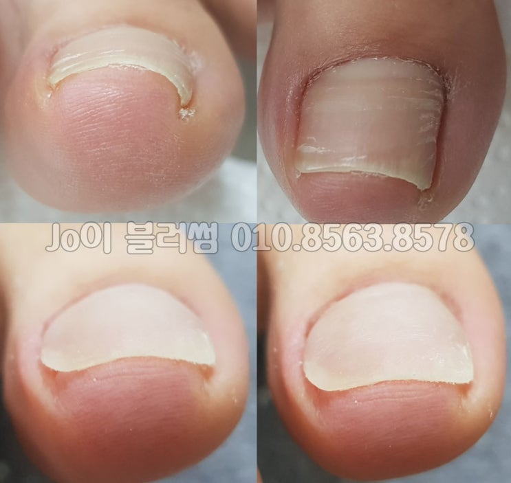  파고드는 발톱은 성별, 나이를 가리지 않습니다. 용인 네일샵 조이블러썸에서 전문관리를 받아보세요.