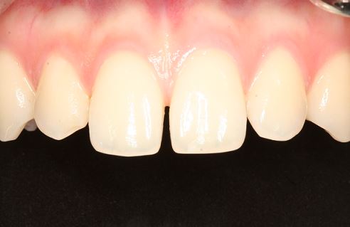 치아성형 할때 최소 삭제 라미네이트가 중요 한 이유?