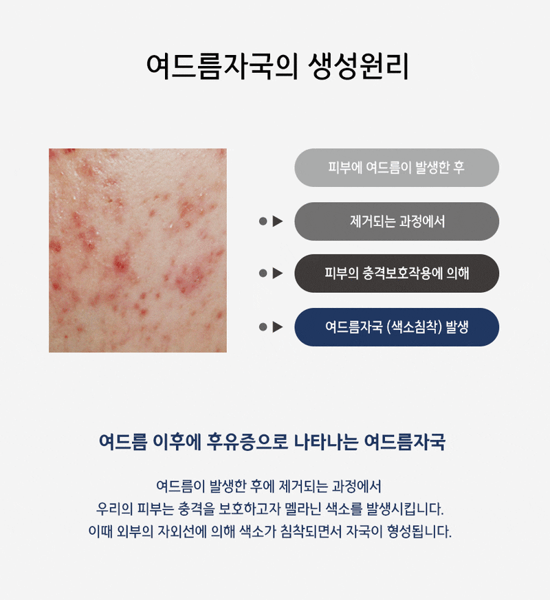 수원가슴여드름 색소침착 없애려면 3
