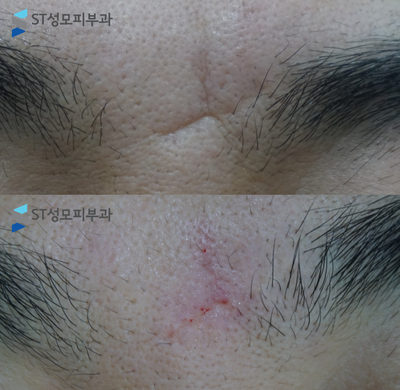  [강남 삼성동 피부과] 피부과전문의가 소개하는 미간 흉터 치료법 '필러수직당김법'이란 (흉터 치료 실제 전후 사진)- ST성모피부과