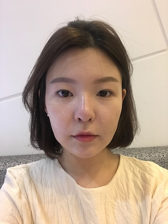  턱살리프팅 확실하게 개선