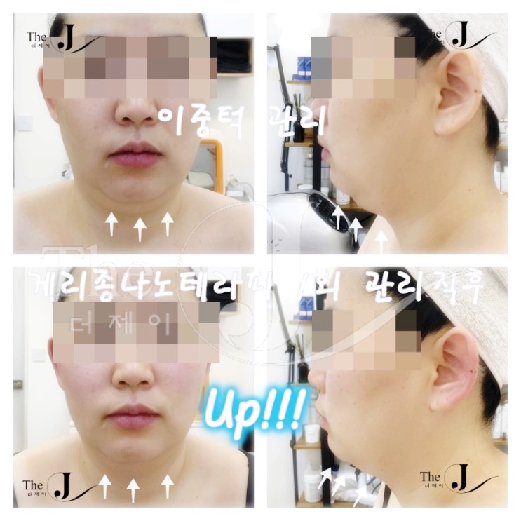 평택피부관리 "더제이" 게리종나노테라피 관리 / 이중턱개선 / 얼굴리프팅 / 문제성 피부 개선