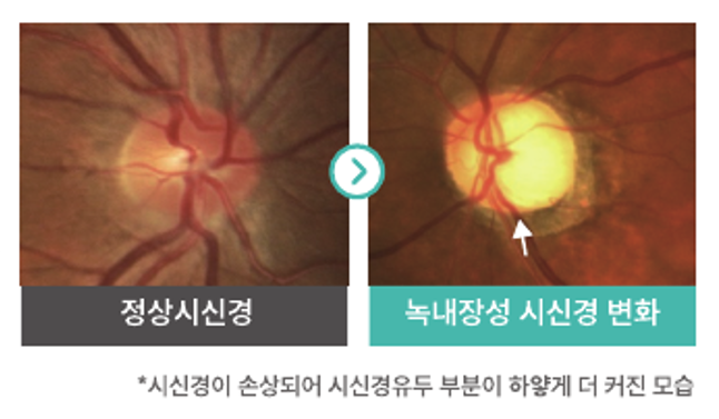 농성 및 건강검진에서 녹내장(시각신경 유두 폐색비 증가)이 의심된다고 했습니다 치료가 필요하십니까?