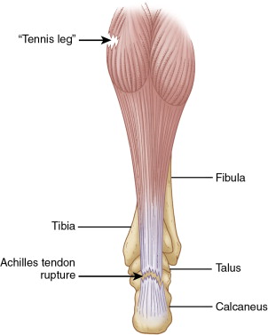 비복근 파열(Tennis leg)