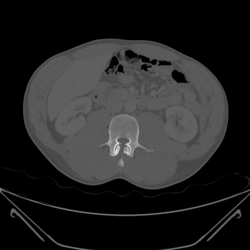 Pulmonary contusion - Rib fx 동반한 lung contusion 증례 : 네이버 블로그