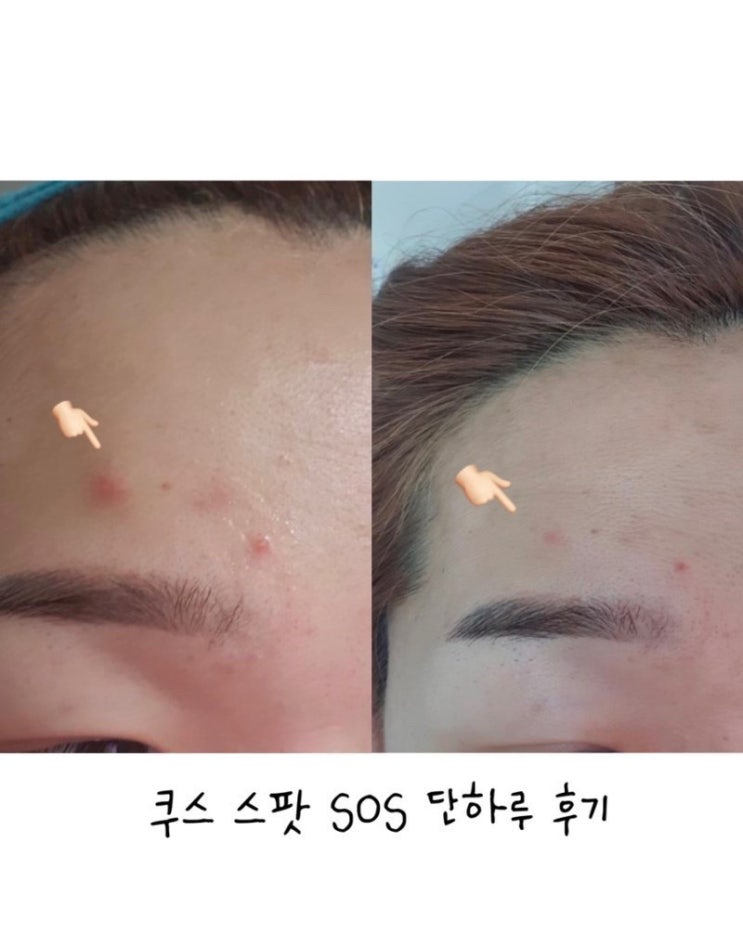  공구기간에만 구매가능한 쿠스스팟롤온 + 쿠스트러블 팩 open