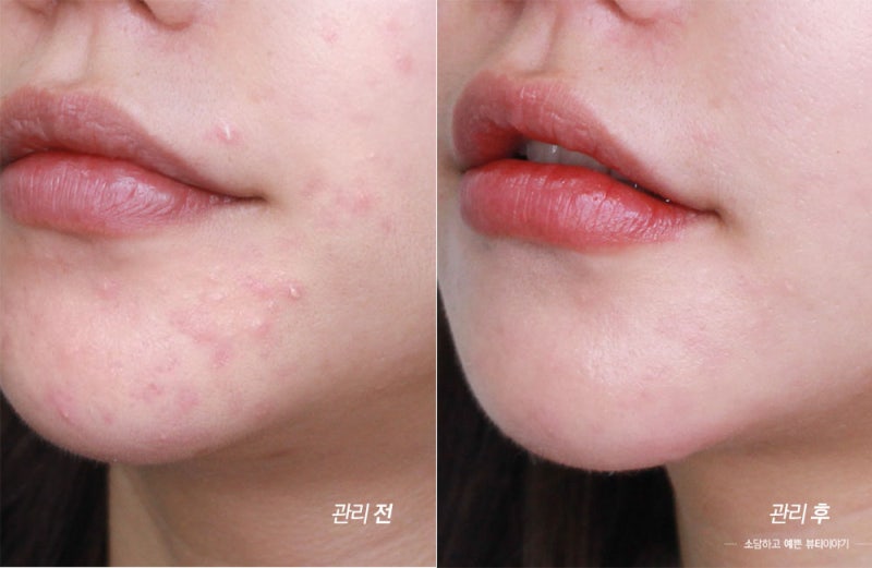 입 주위의 여드름에 대한 스킨 케어 제품 변경 입 주위의 여드름에 대한 스킨 케어 제품 변경