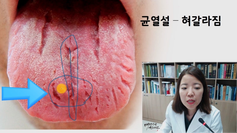 혀 갈라짐, 균열설 원인과 치료방법 : 네이버 블로그