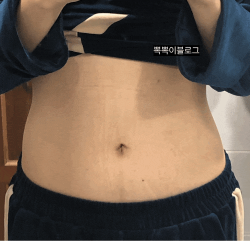 복부지방분해주사 맞고 -5.9kg 빠진 5차 후기