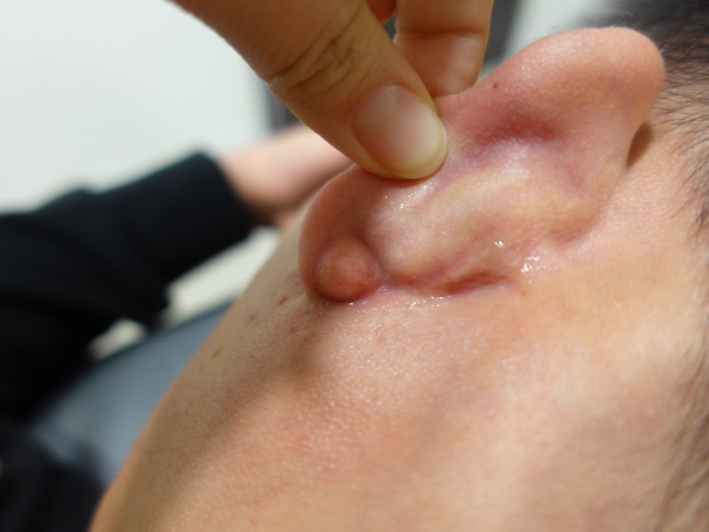 Dr.Park] 귀 귓불에 발생한 피지낭종 그리고 얼굴에 발생한 피지낭종 핀홀법 국소마취 제거 수술 : 네이버 블로그