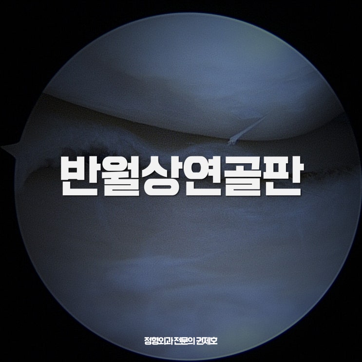 슬관절 무릎 손상, 반월상 연골판 Meniscus feat. 제이본정형외과 권제호!